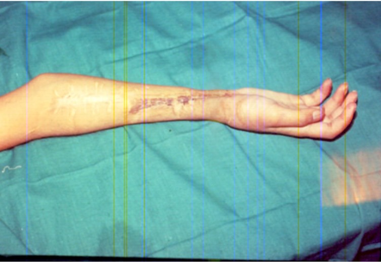 Real-life story: Reconstruction of hand and dramatic recovery