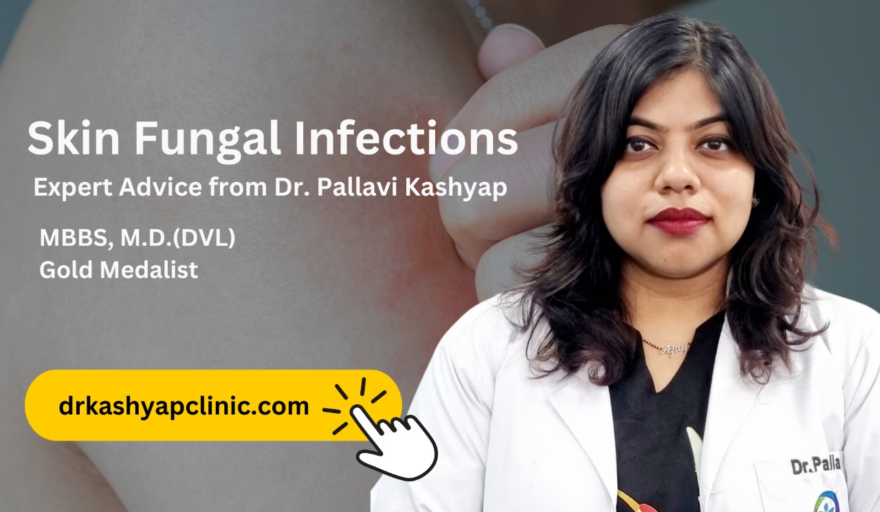 Understanding Skin Fungal Infections: Causes, Symptoms, and Treatment by Dr Pallavi Kashyap